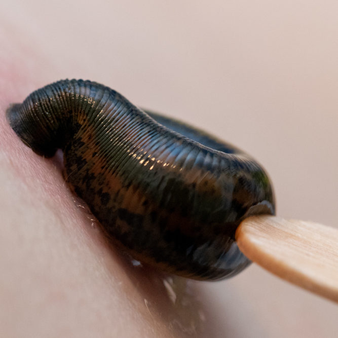 Aufsetzen der Blutegel zur Schmerzlinderung