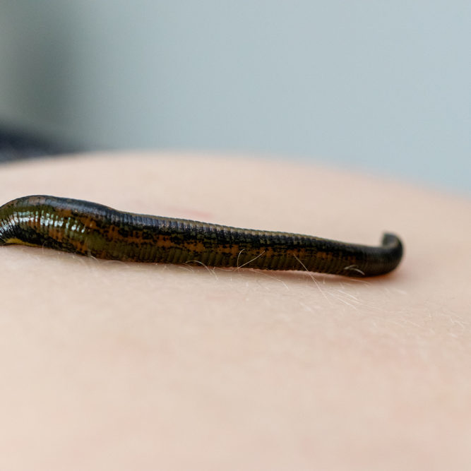 Sanfte Schmerzbehandlung: Blutegeltherapie