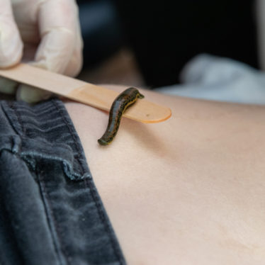 Blutegeltherapie Rico Junghans